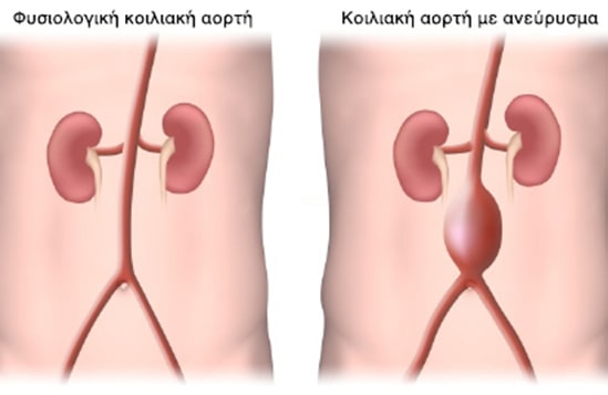 Aneurisma koiliakis aortis