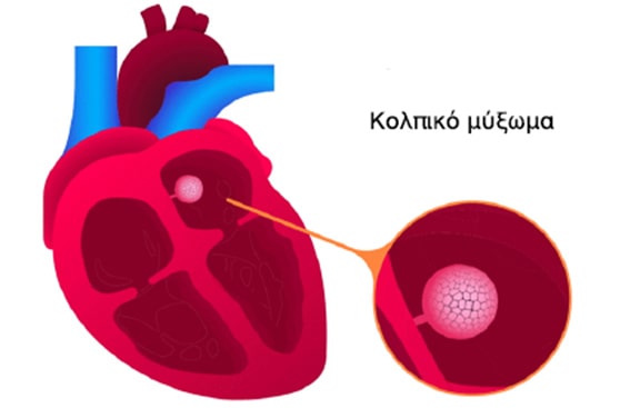 Kolpiko miksoma