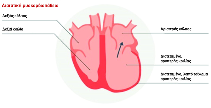 Diatatiki muokardiopatheia