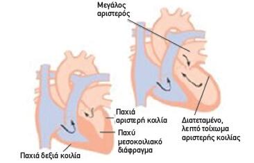 Miokardiopatheia